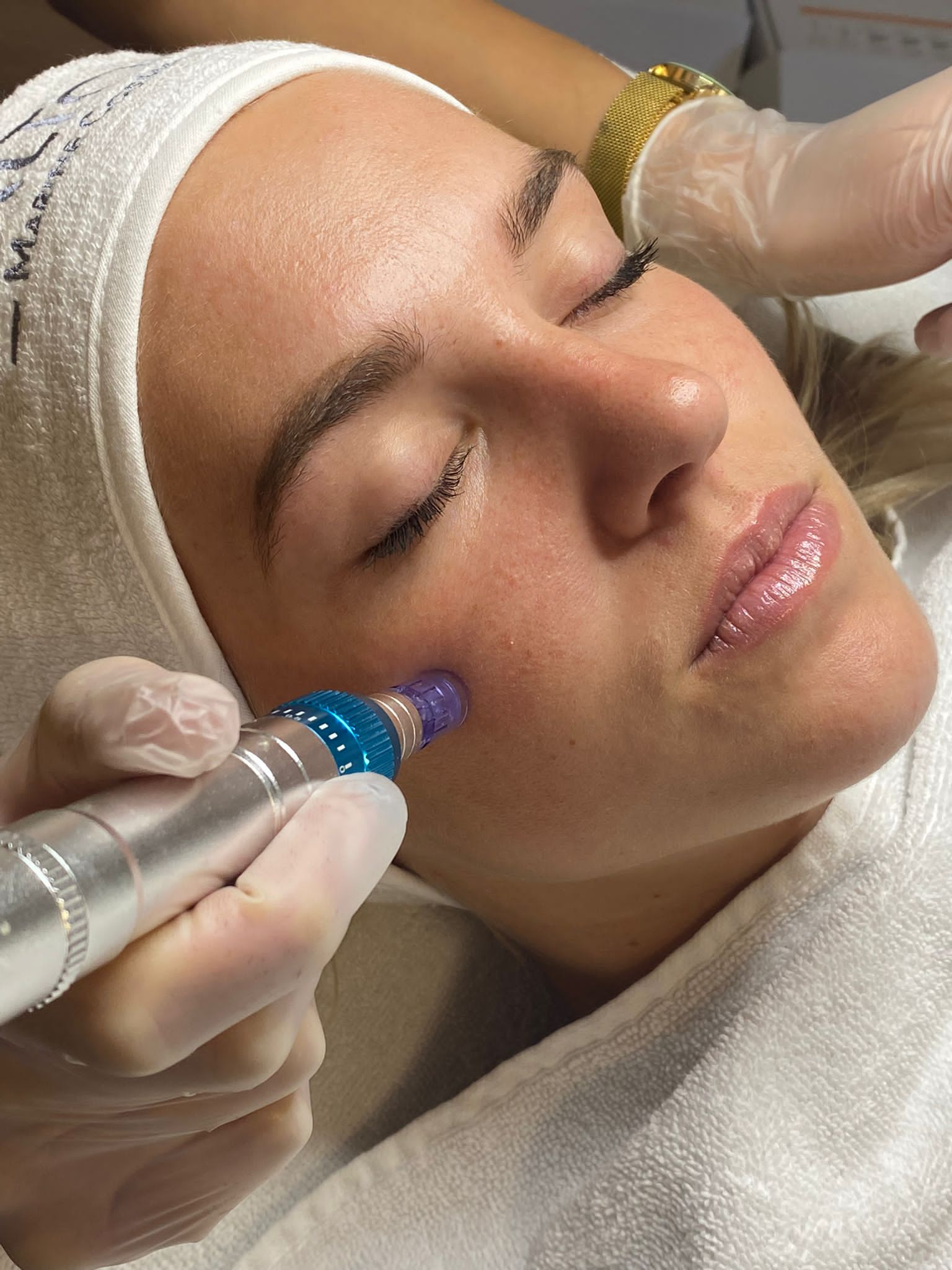 Microneedling